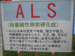 ＡＬＳの症状